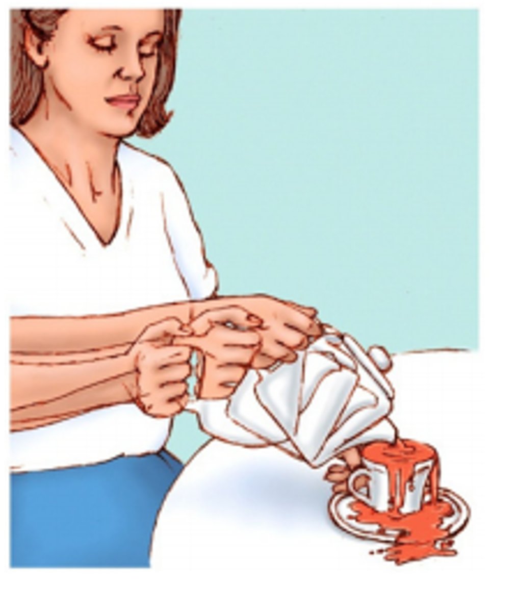 <p>the inability to perceive motion that arises from damage to V5/MT - the motion area; patients experience a strobe-light effect of vision. It can be caused by damage such as stroke, trauma and rarely from antidepressants</p>