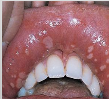 <p>Herpetiform Recurrent Aphthous Ulcer</p>