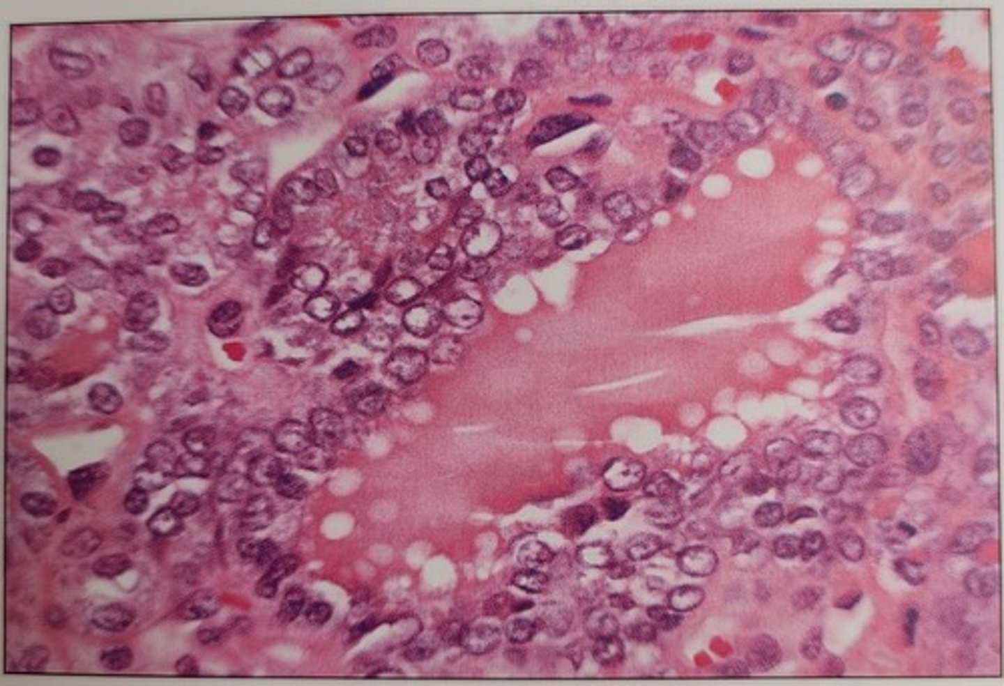 <p>b. incomplete fixation</p><p>- Nuclear bubbling is most often the result of placing the incompletely fixed tissue in the dehydrating solutions</p>