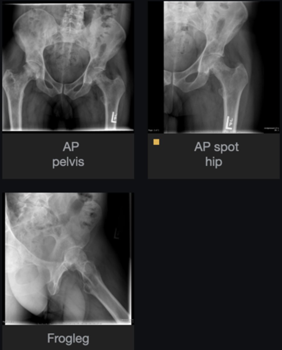 <p>Soft tissue involvement</p>