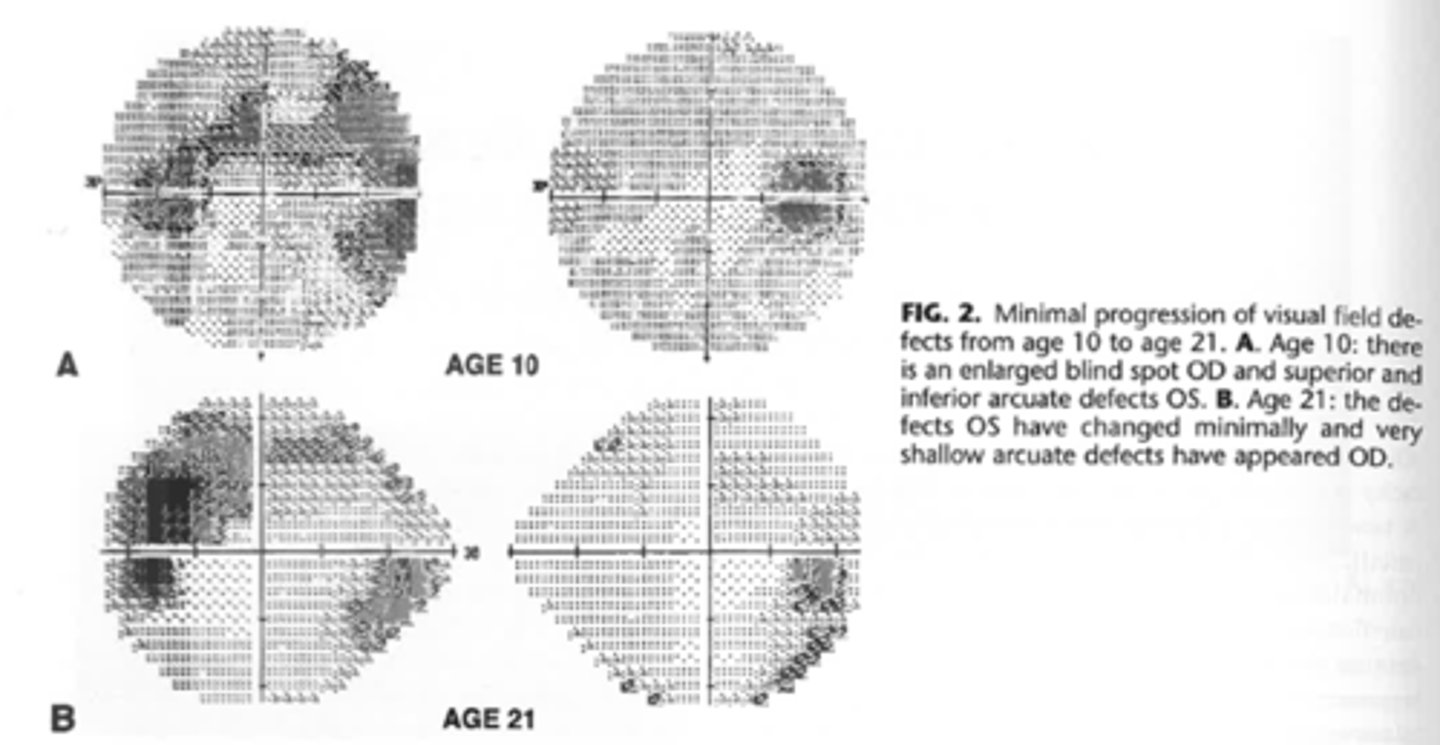 <p>VF defects may develop, including an enlarged blindspot and arcuate defect</p>