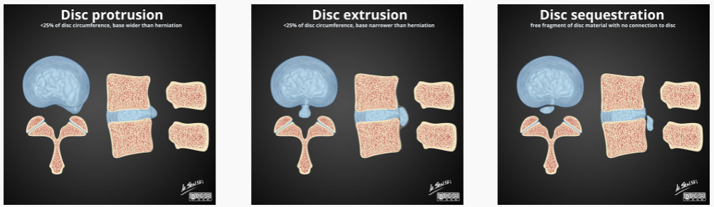 <ul><li><p>degenerative (common) or traumatic (rare)</p></li><li><p>types:</p><ul><li><p>protrusion = annular fiber intact</p></li><li><p>extrusion = annular fiber tear but nucleus intact</p></li><li><p>sequestration = nucleus is severed </p></li></ul></li></ul><p></p>