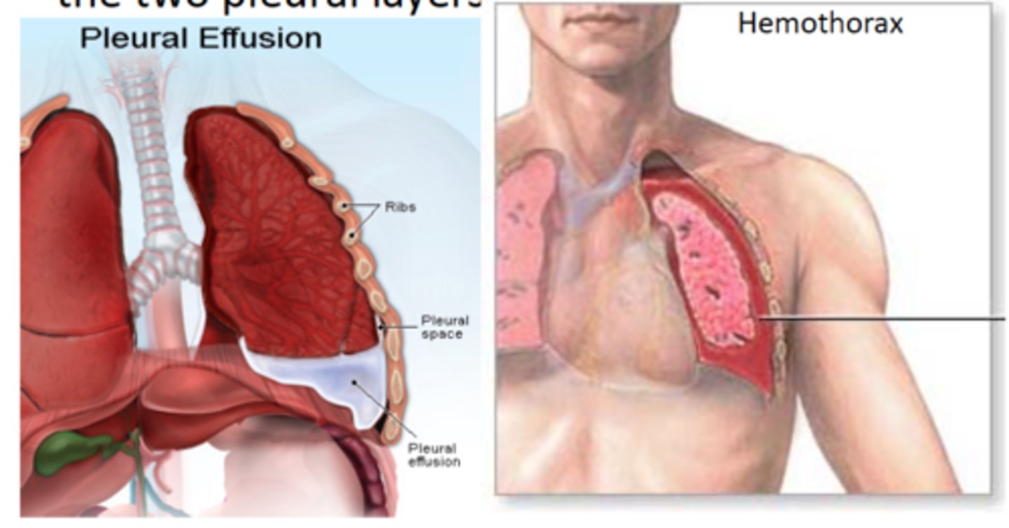 <p>blood in the pleural space</p>