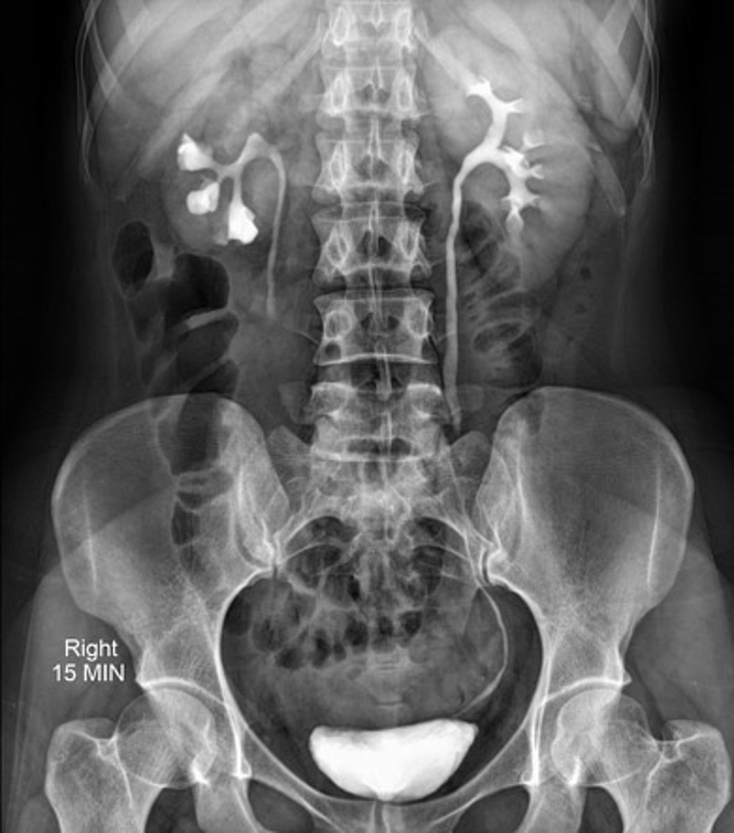 <p>Dit radiologische beeld wordt benoemd als 'drooping lily', dit wijst op?</p>