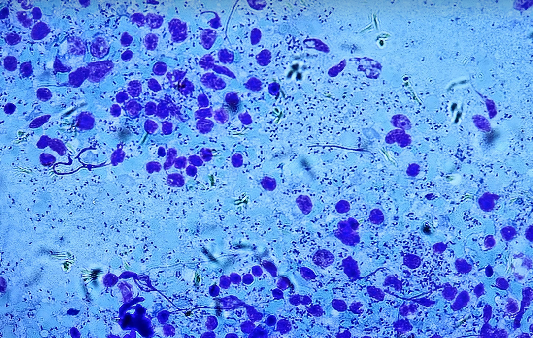 <p><span data-name="microscope" data-type="emoji">🔬</span><span data-name="petri_dish" data-type="emoji">🧫</span><strong><span> </span>Na podstawie zdjęcia preparatu:</strong></p><p></p><ul><li><p><span data-name="book" data-type="emoji">📖</span><span> </span>rozpoznaj gatunek pasożyta;</p></li></ul><p></p><ul><li><p><span data-name="recycle" data-type="emoji">♻</span><span> </span>rozpoznaj wszystkie formy rozwojowe;</p></li></ul><p></p><ul><li><p><span data-name="microbe" data-type="emoji">🦠</span><span> </span>wskaż organelle i cechy charakterystyczne dla danego gatunku;</p></li></ul><p></p><ul><li><p><span data-name="mask" data-type="emoji">😷</span><span> </span>nazwij chorobę, którą pasożyt wywołuje.</p></li></ul><p></p>