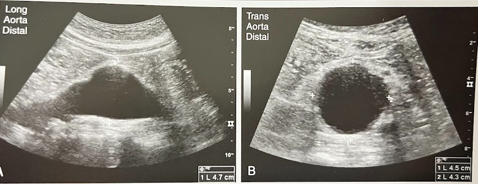 <p>A 63 year old man is seen for evaluation of a possible renal mass seen on a radiograph. The sonogram reveals a rt renal cyst. Incidentally noted are the findings in the Ao images. The aorta measured 4.7cm in AP diameter. What is the most likely diagnosis?</p>