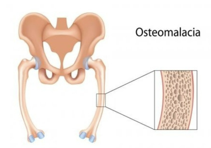 <ul><li><p>Group of diseases in which <strong>bones are poorly mineralized</strong></p></li><li><p>Results in <strong>weak and soft bones</strong></p></li><li><p><strong>Calcium salts not sufficient</strong></p></li><li><p><strong>Childhood version:</strong> Rickets</p><ul><li><p><strong>Bowed legs</strong></p></li><li><p><strong>Deformities</strong> to the skull, pelvis, and ribs</p></li></ul></li></ul><p></p><p></p>