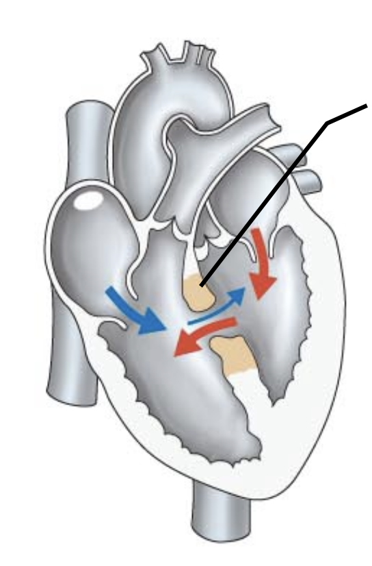 <p>what kind of congenital heart defect is this?</p>