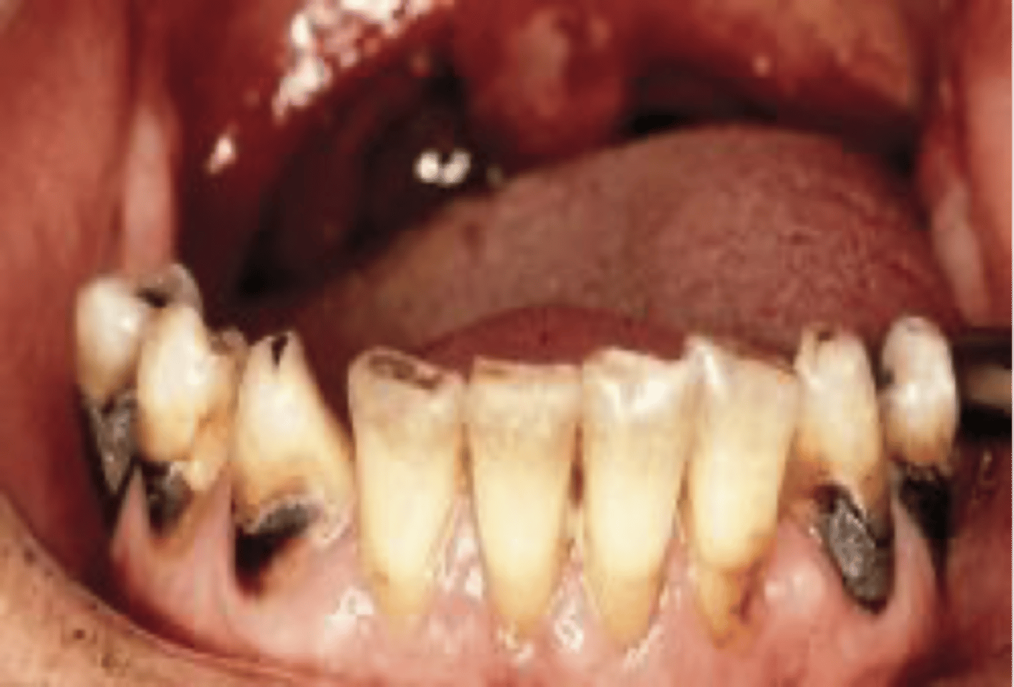 <p>Soft progressive lesion of cementum and dentin</p><p>Gingival recession</p><p>Strength of CEJ</p>