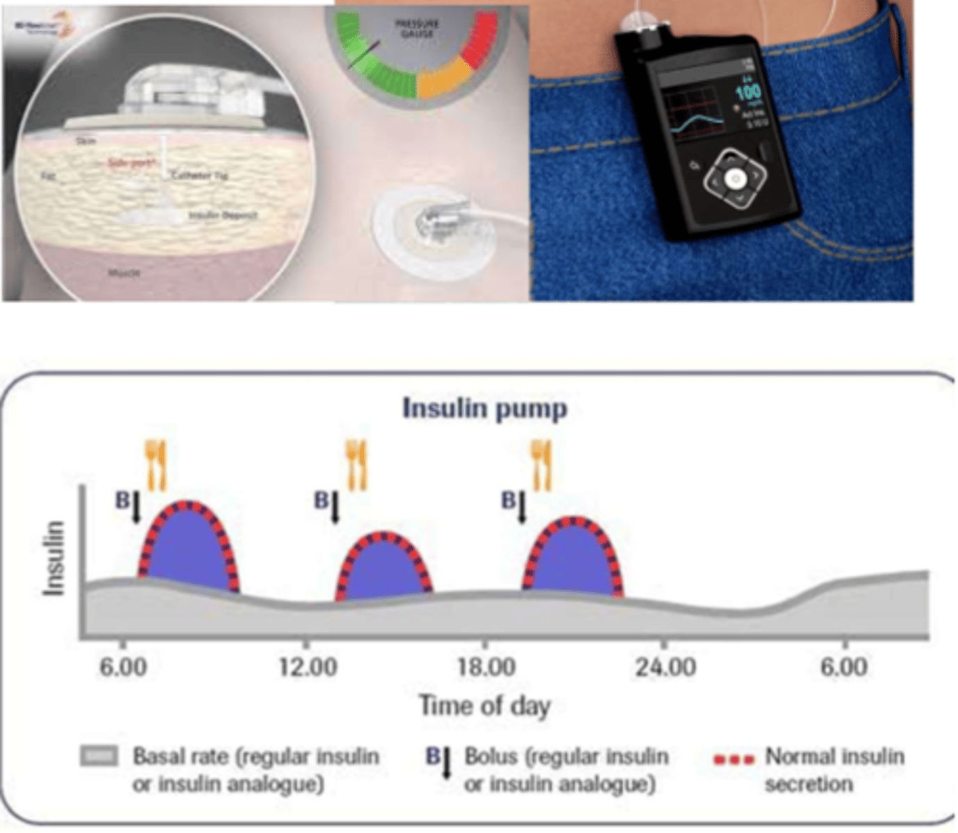 <p>- slow infusion of rapid acting insulin over 24 hrs (ongoing trickle)</p><p>- careful monitoring (bedtime BG)</p><p>- endocrinology appointments</p>
