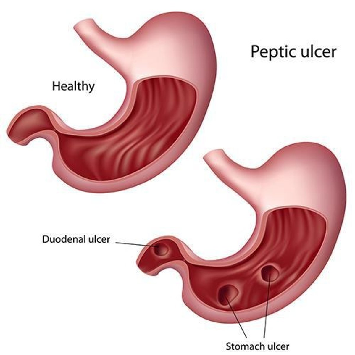 <p>Holes that can form in the wall of the stomach due to overproduction of gastric acid, increased by an infection of the bacterium Helicobacter pylori.</p>