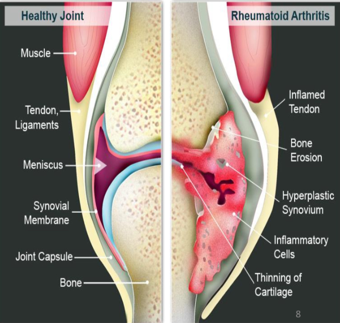<p>Autoreactive T cells and B cells attack self-antigens present in joints, affects 1% of population. Often late onset in life.</p>