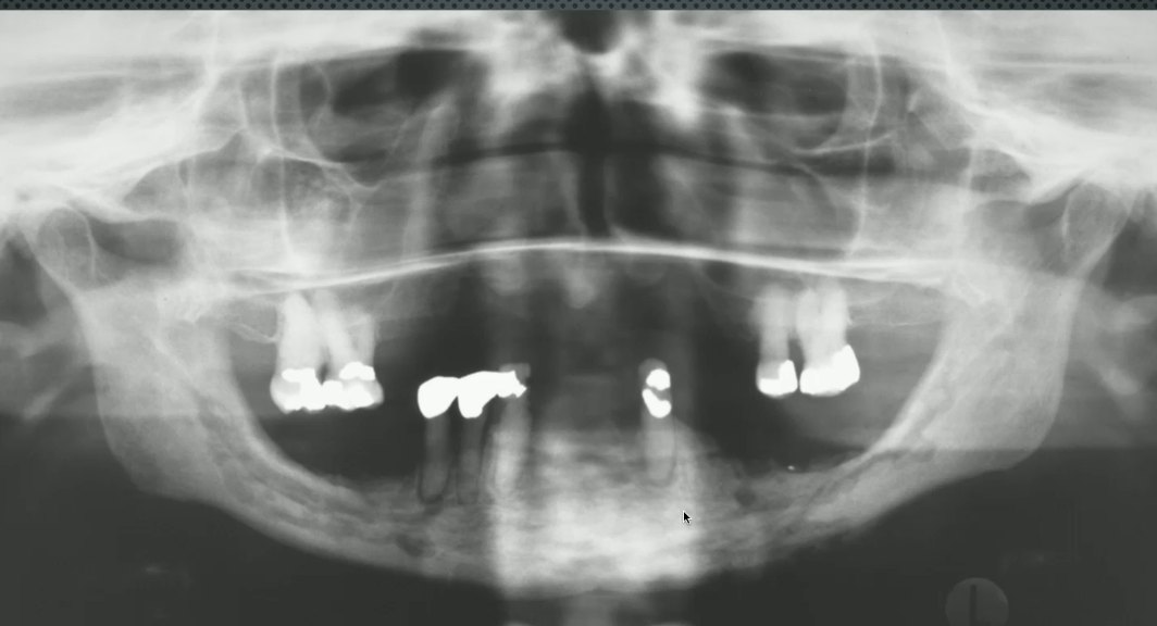 <p>no history of antiresorpative medications, <strong>PAINFUL</strong> , what is the likely diagnosis?</p>