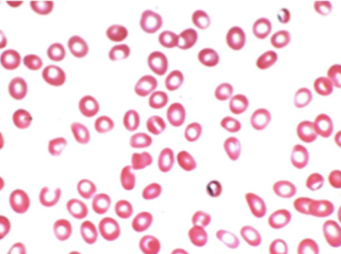 <p>what type of anemia</p>