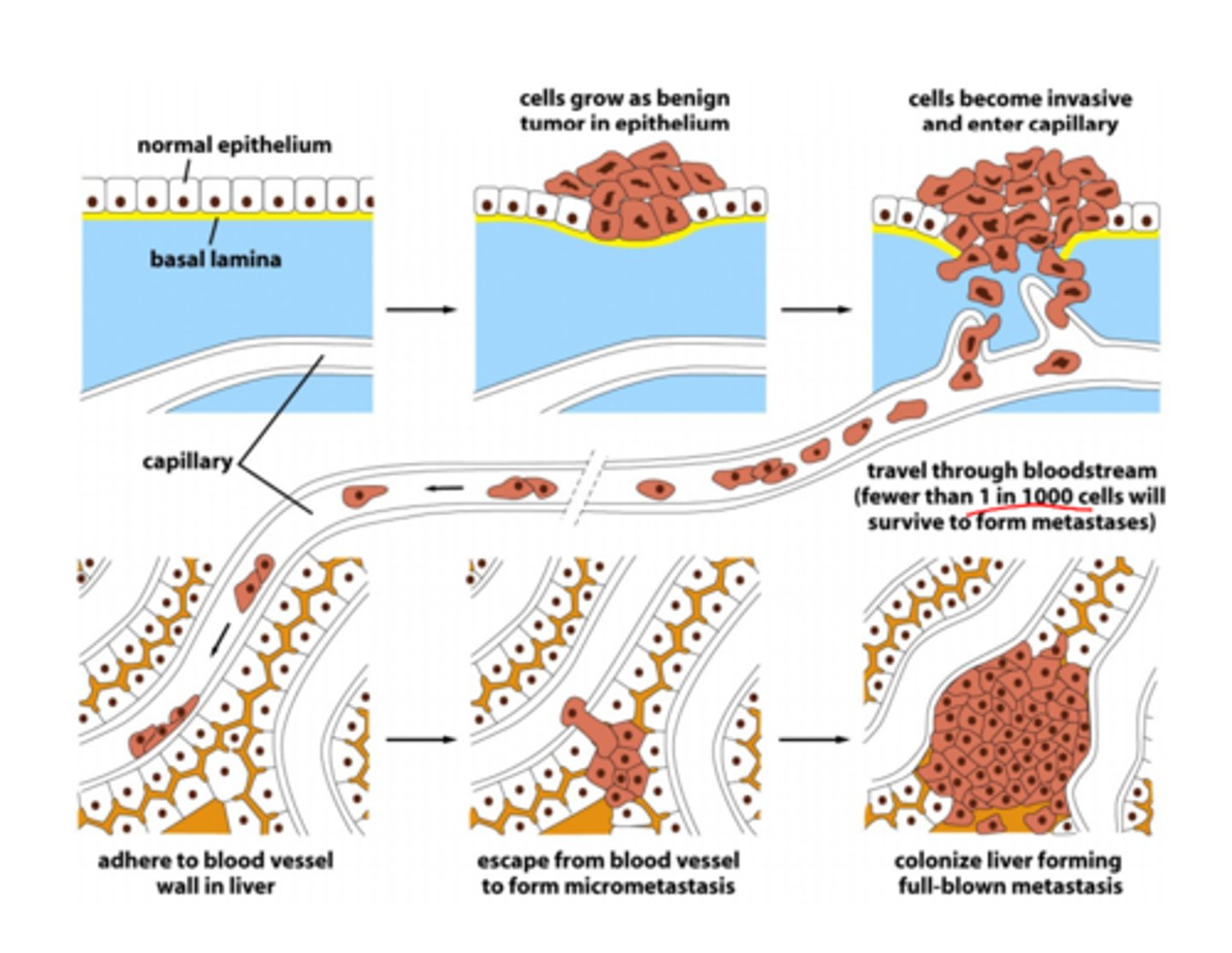 <p>1. Direct or continuous extension</p><p>2. Penetration into lymphatics, blood vessels, or body cavities</p><p>3. Transport into lymph or blood</p><p>4. Transport to secondary sites</p><p>5. Entry and growth in secondary sites</p>