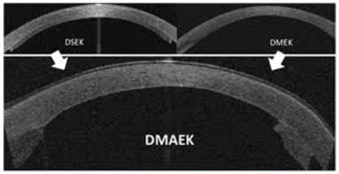 <p>Why was the DMAEK created from a hybrid of DSAEK and DMEK?</p>