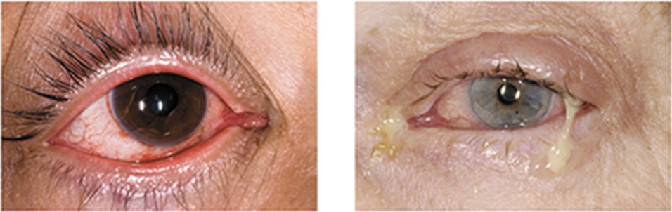 <p>which picture likely represents viral conjunctivitis?</p>