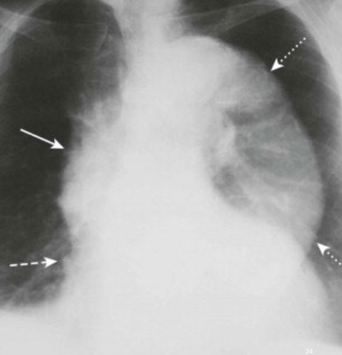 <p>this CXR shows abnormalities in which areas</p>
