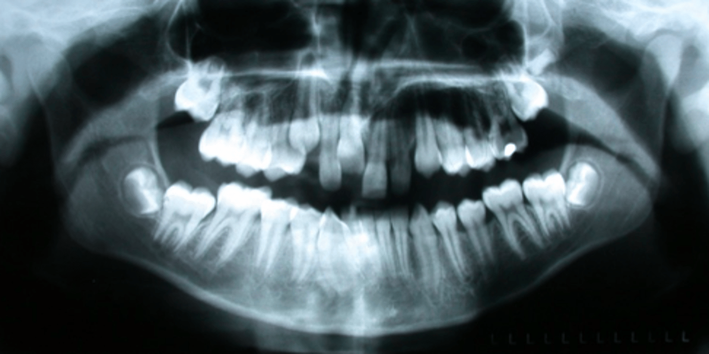 <p>ID the developmental disturbance:</p>