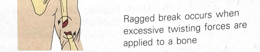 <p>fracture in which broken bones are twisted, spiral shape</p>