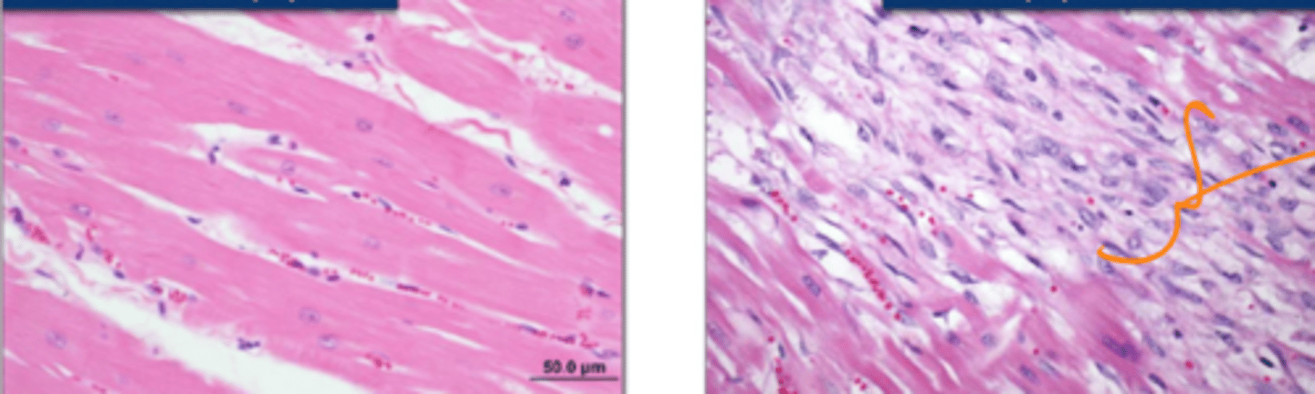 <p>What are the cellular stages of cardiac hypertrophy?</p>