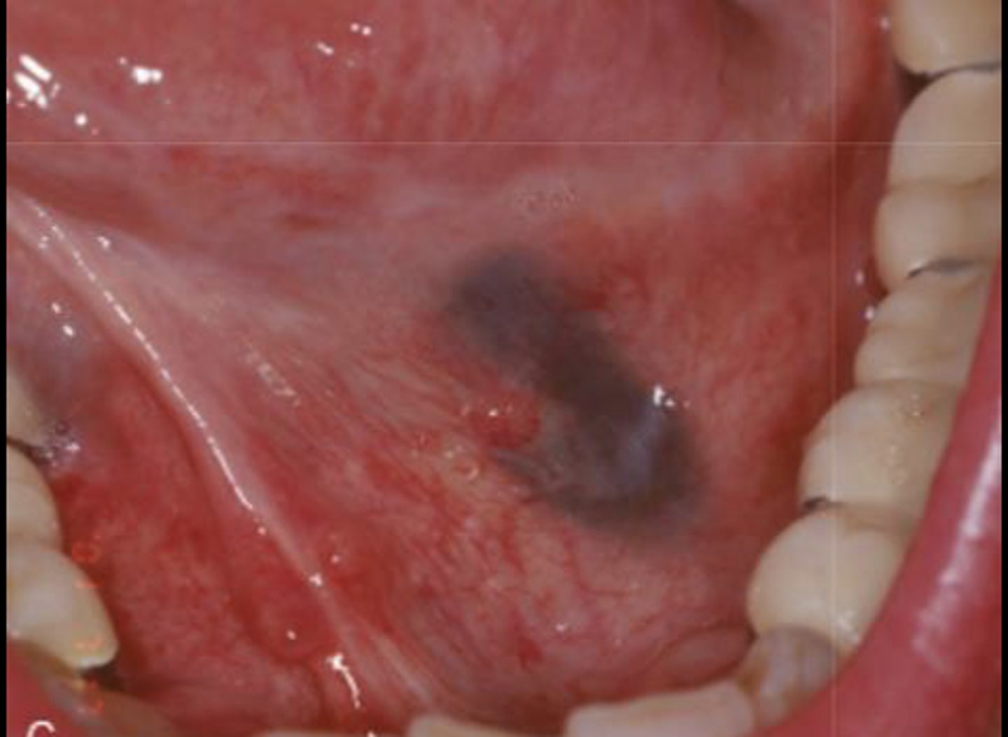 <p>What type of pigmented lesion?</p>