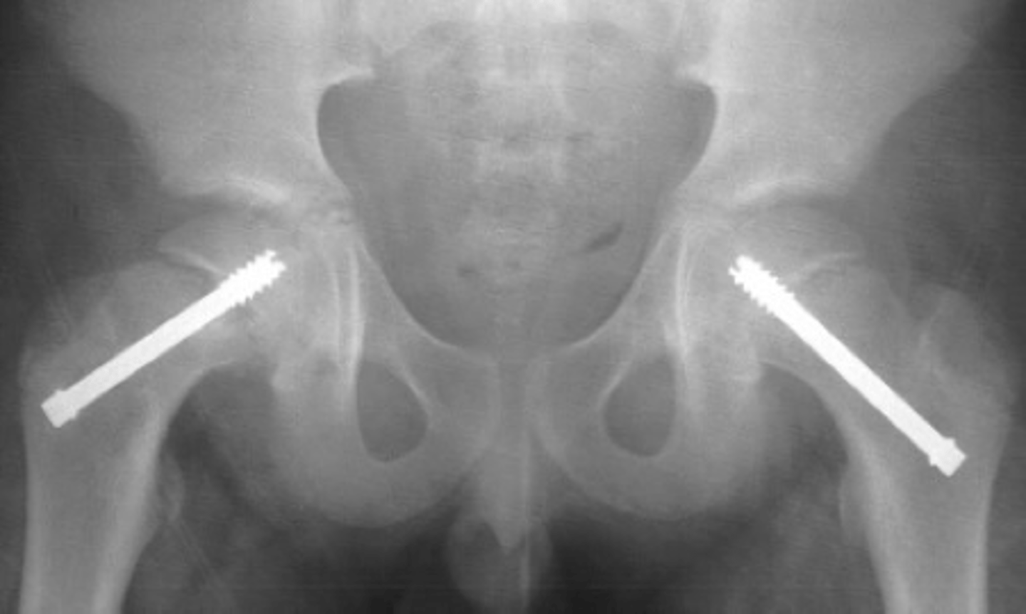 <p>Refer to ortho for surgery</p><p>Surgery: Percutaneous pin fixation </p><p>(+/- prophylactic pin fixation of contralateral hip in high-risk patients)</p>