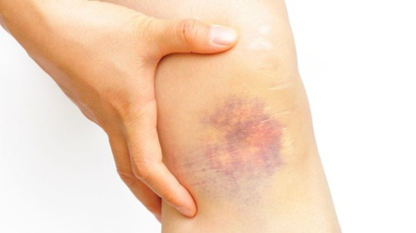 <p>a dark mark on the skin after a hit: vết bầm</p>