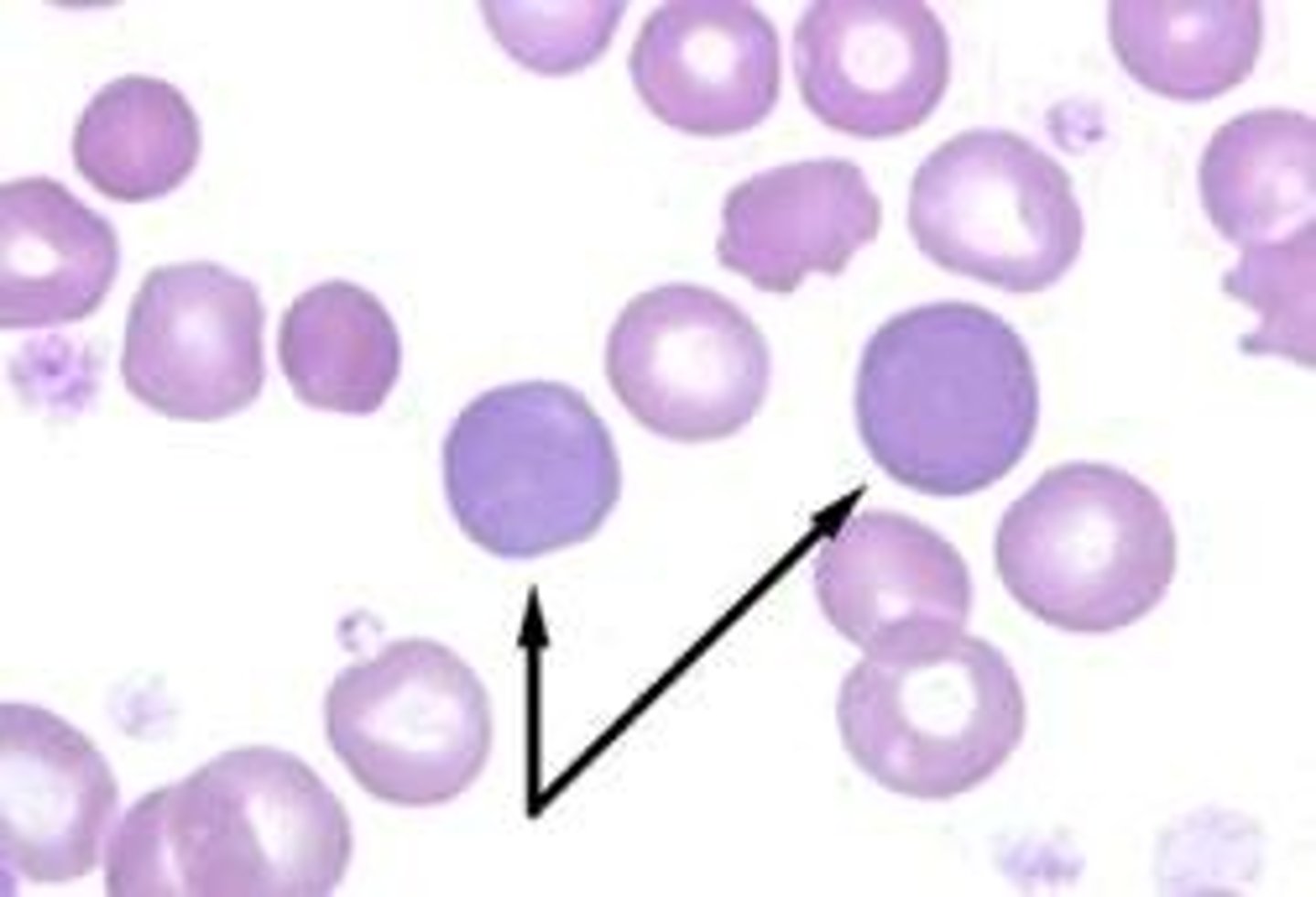 <p>Reticulocyte/ polychromic erythrocyte <br>- no nucleus<br>-purple cytoplasm<br>- 0.5-2.5% BM</p>