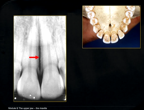 <p>mid-palatal suture </p>