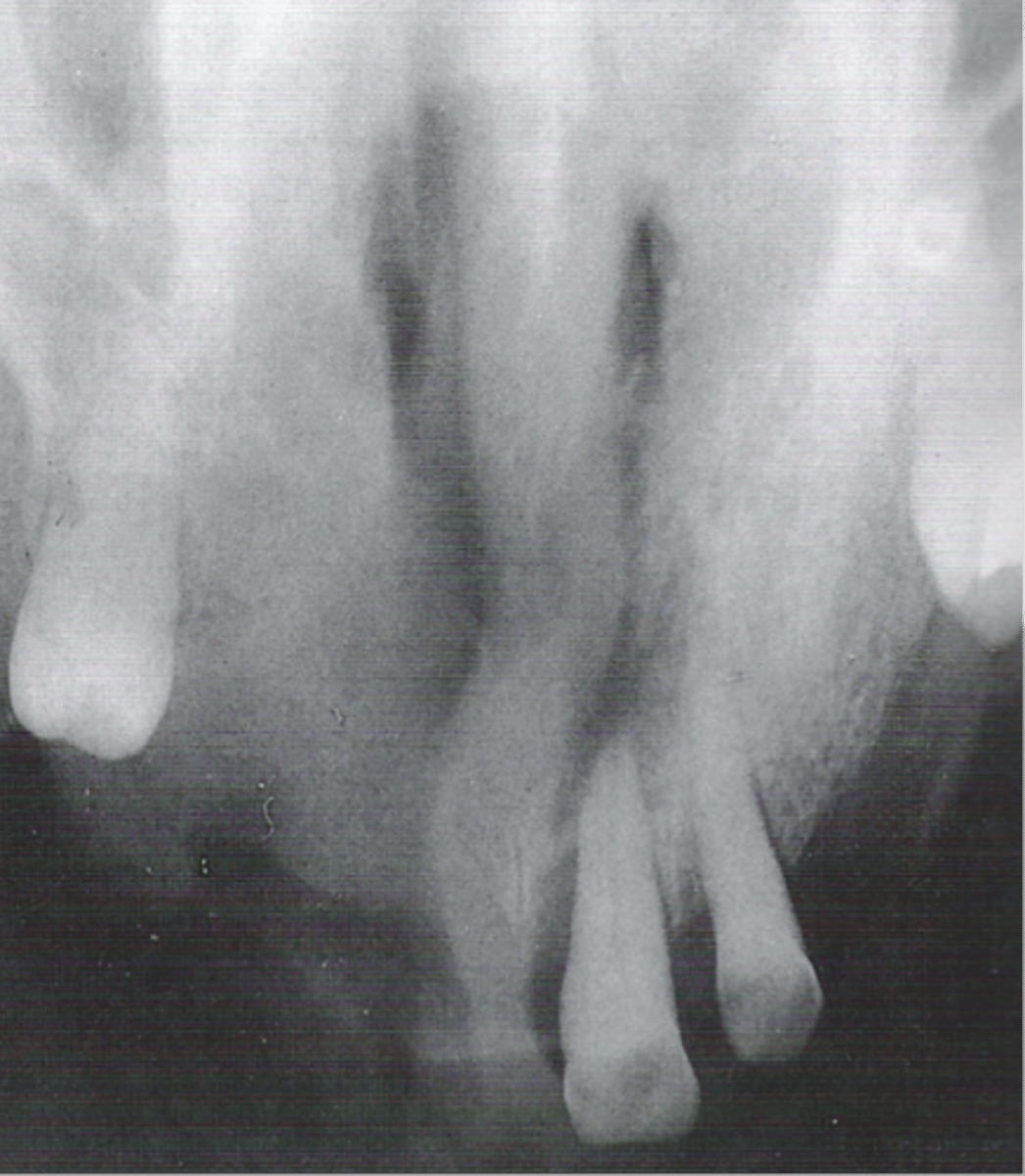 <p>Diffuse</p>