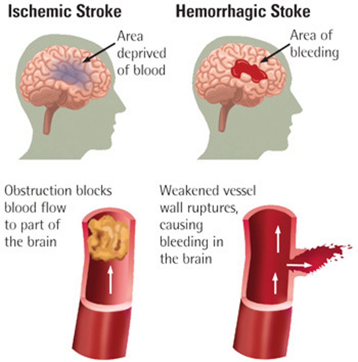 <p>a.k.a. "Stroke". Lack of blood supply to the brain causes brain damage</p>
