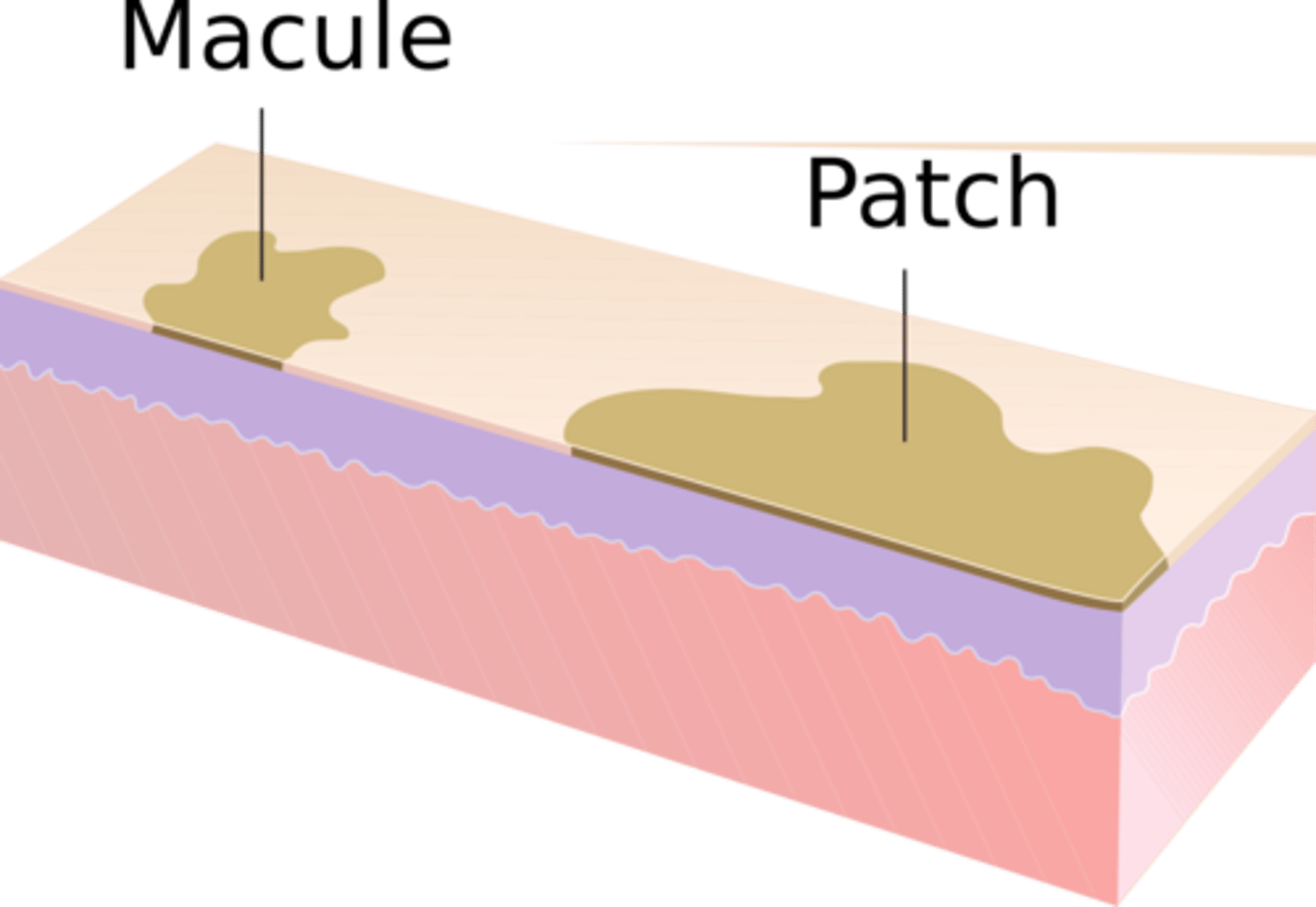 <p>macular lesions</p><p>circumscribed</p><p>&gt; 1 cm</p>