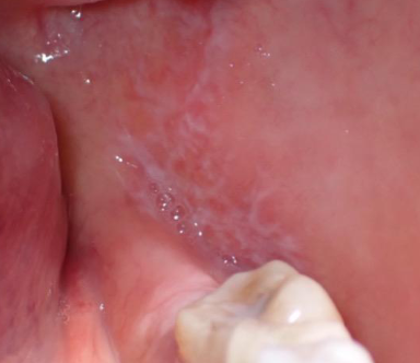 <p>white lacey striations (wickham striae) </p>