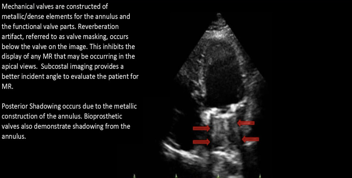 <p>Normal finding with prosthetic valves</p>