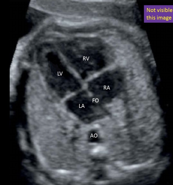 <p>where is ascending AO - not seen in this image</p><ul><li><p>type “seen in LVOT tract + aortic arch view”</p></li></ul><p>this is descending AO</p>
