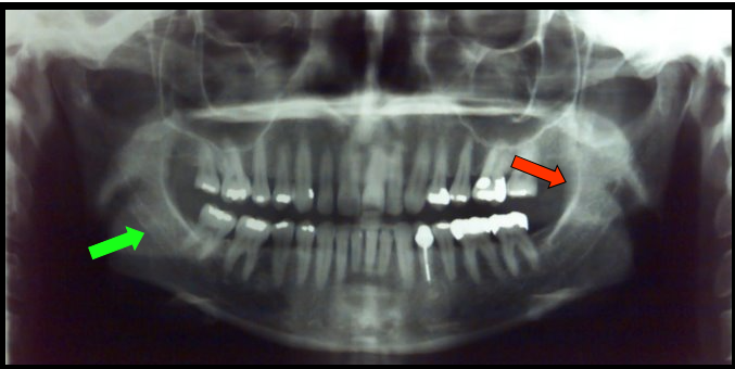 <ul><li><p><span>Appears as a radiolucent band outlined by two thin radiopaque lines representing the cortical walls of the canal.</span></p></li><li><p><span>Appears as a dense radiopaque band that extends downward and forward from the ramus to the molar region.</span></p></li></ul><p></p>