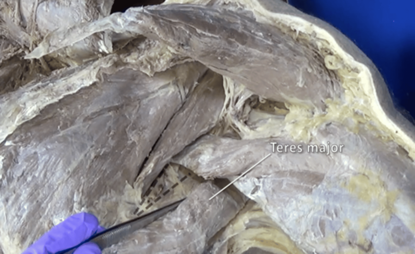 <p>extension, adduction, and medial rotation of arm</p>