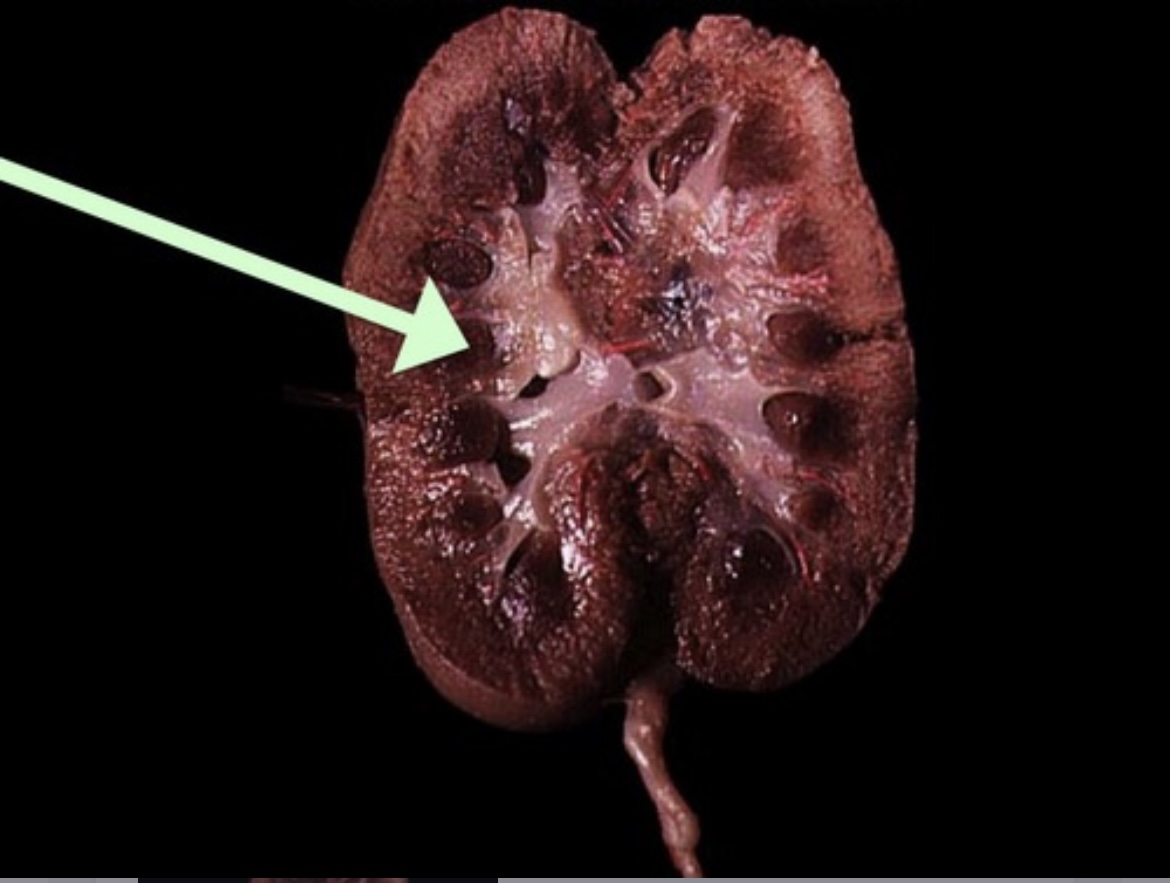 <p>Conical segment of the medulla that funnels urine into minor calyces.</p>