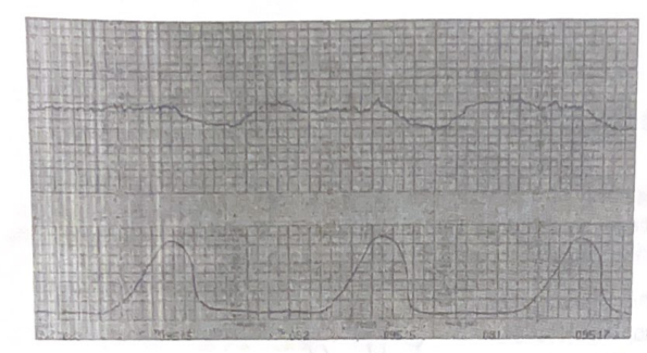 <p>The nurse is caring for a client in labor and observes the fetal monitor strip below. Which of the following is the correct assessment to document regarding fetal deceleration?</p>