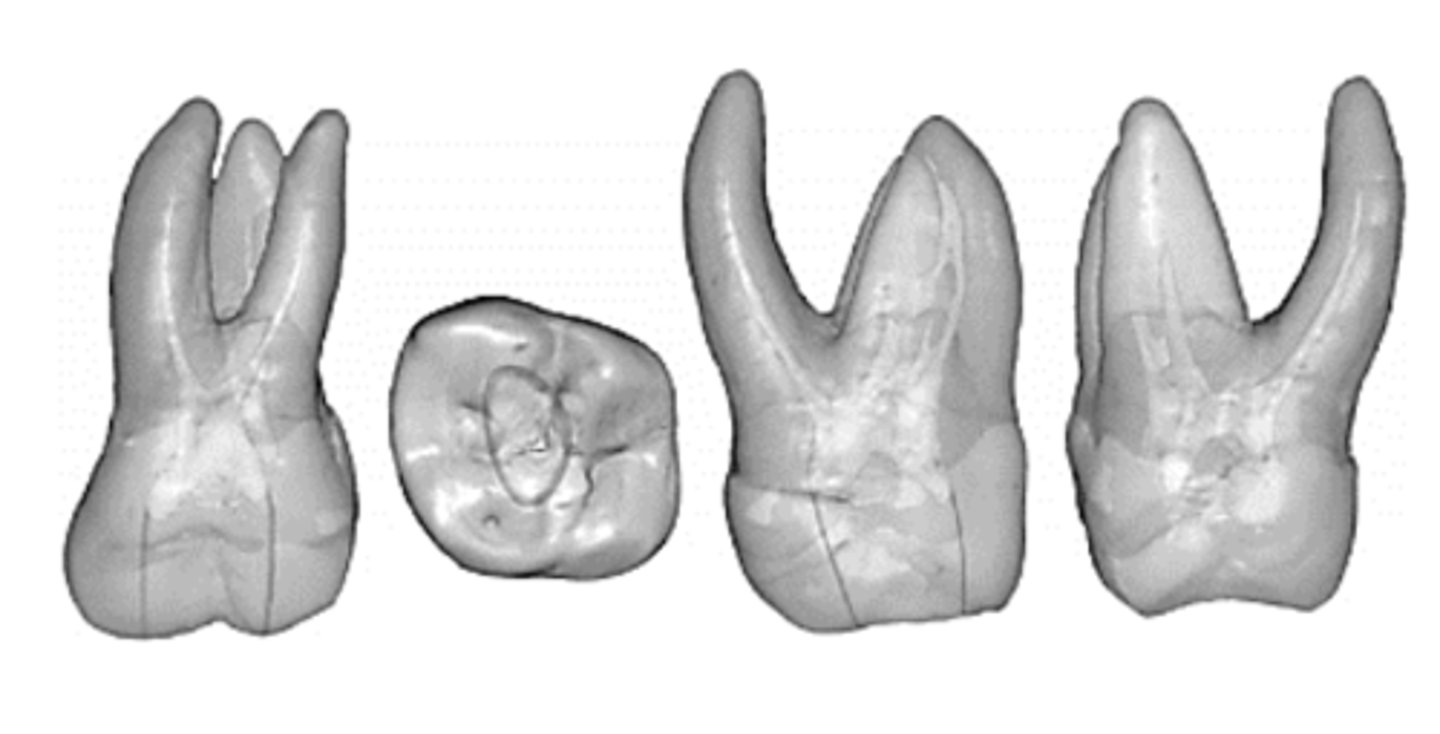 <p>maxillary 2nd molar</p>
