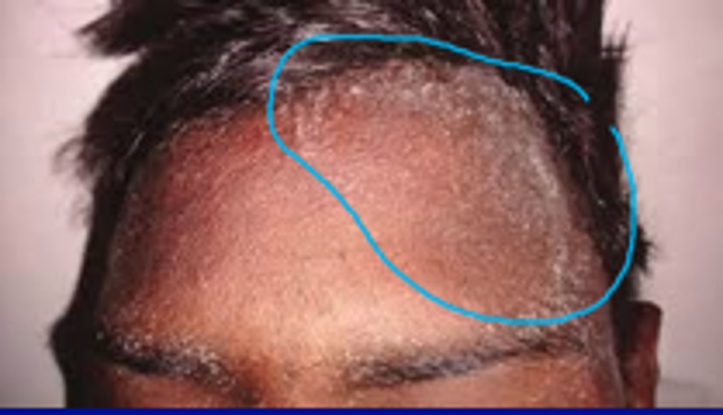 <p>Uremic frost</p>