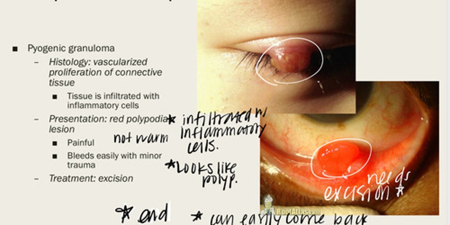 <p>vascularized proliferation of connective tissue that is infiltrated with inflammatory cells in a red polypodia lesion</p>