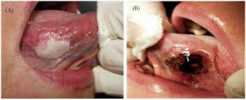 <p>type of leukoplakia that is speckled between white and red lesions, higher risk of oral cancer </p>