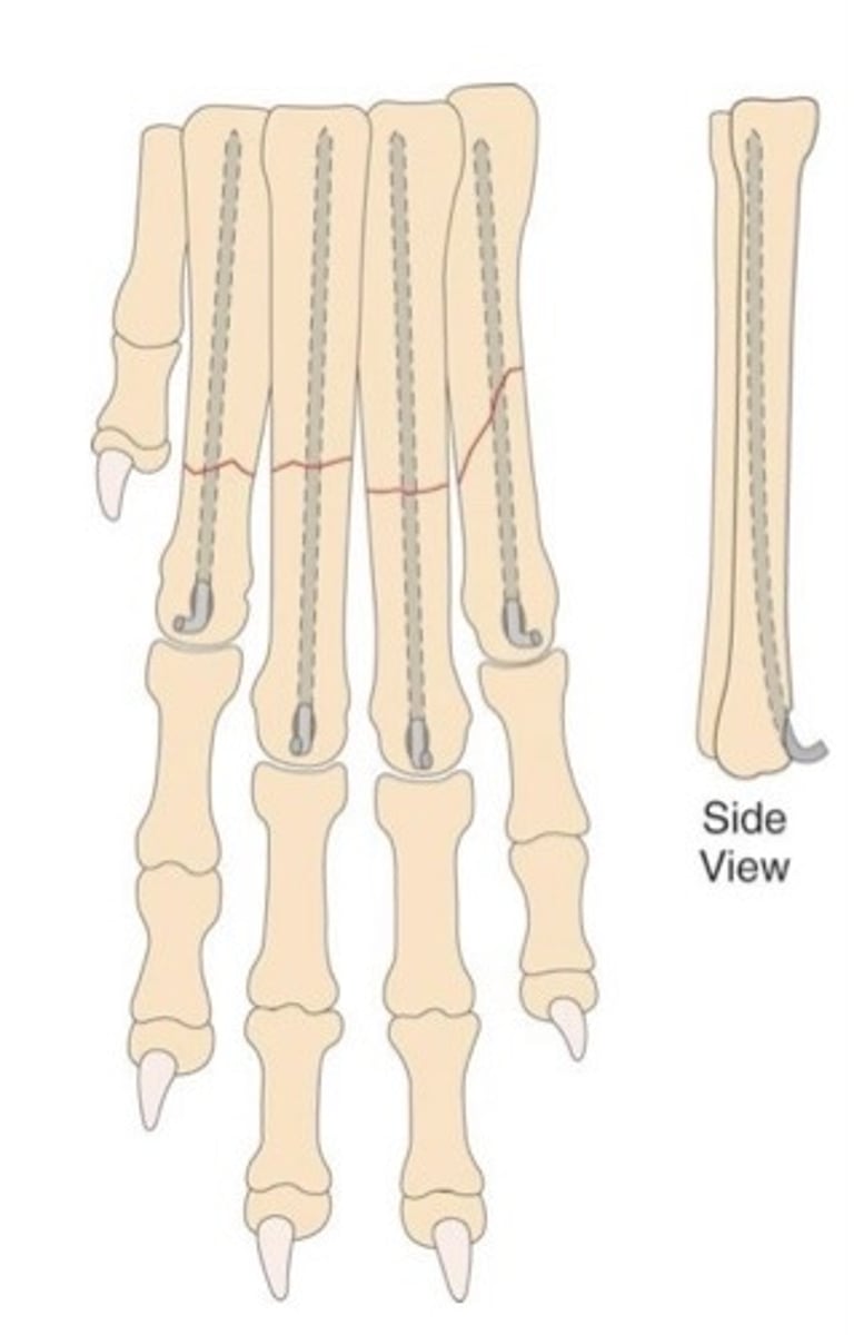 <p>What is the treatment for these metacarpal/metatarsal fractures?</p>