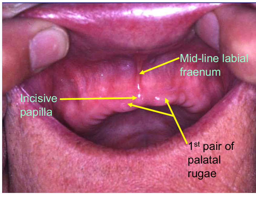 <p>Don’t want denture to rest on frenal attachment</p>