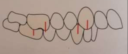 <p>1st lower molar Buccal groove occludes <strong>distally</strong> with 1st upper mesiobuccal</p>