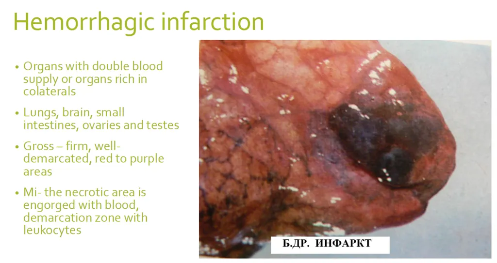 <p><strong><span>Indicate the correct statement(s) for haemorrhagic infarction</span></strong>. (2)</p><p><strong>a) it develops in organs with double circulation </strong></p><p>b) it mainly affects the brain and the heart </p><p>c) it affects organs which have contact with the outside environment </p><p><strong>d) it may affect the small intestine</strong></p>
