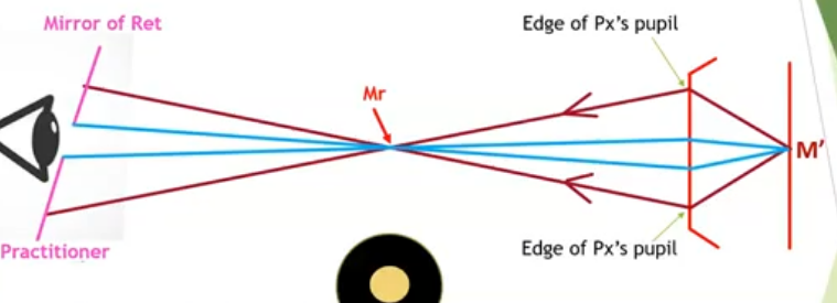 <p>high myopia: Mr is between patient and practitioner and far from the ret&nbsp;</p>
