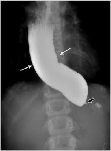 <p>Ulcers/erosion</p><p>Slow esophageal peristalsis</p><p>Dilation of esophagus</p>